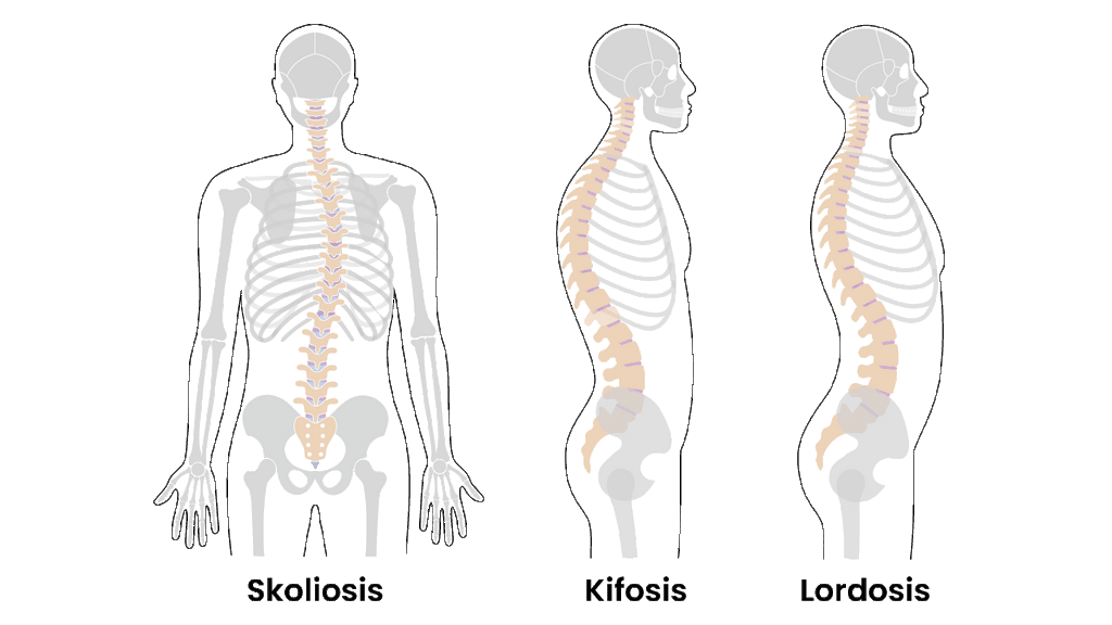 Tulang punggung terlalu bengkok ke belakang atau bungkuk
